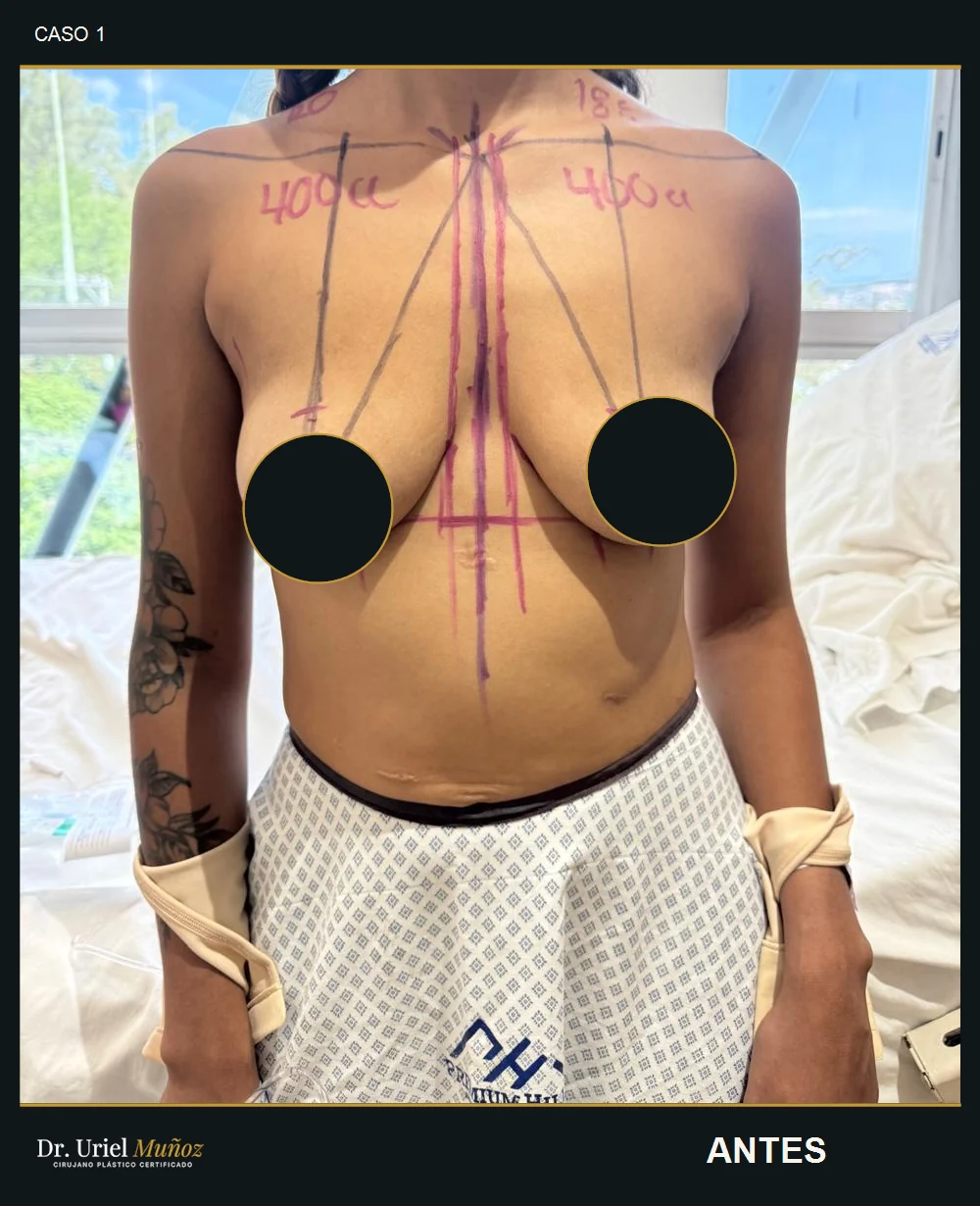 Caso 1, fotografía frontal antes del aumento de senos con implantes