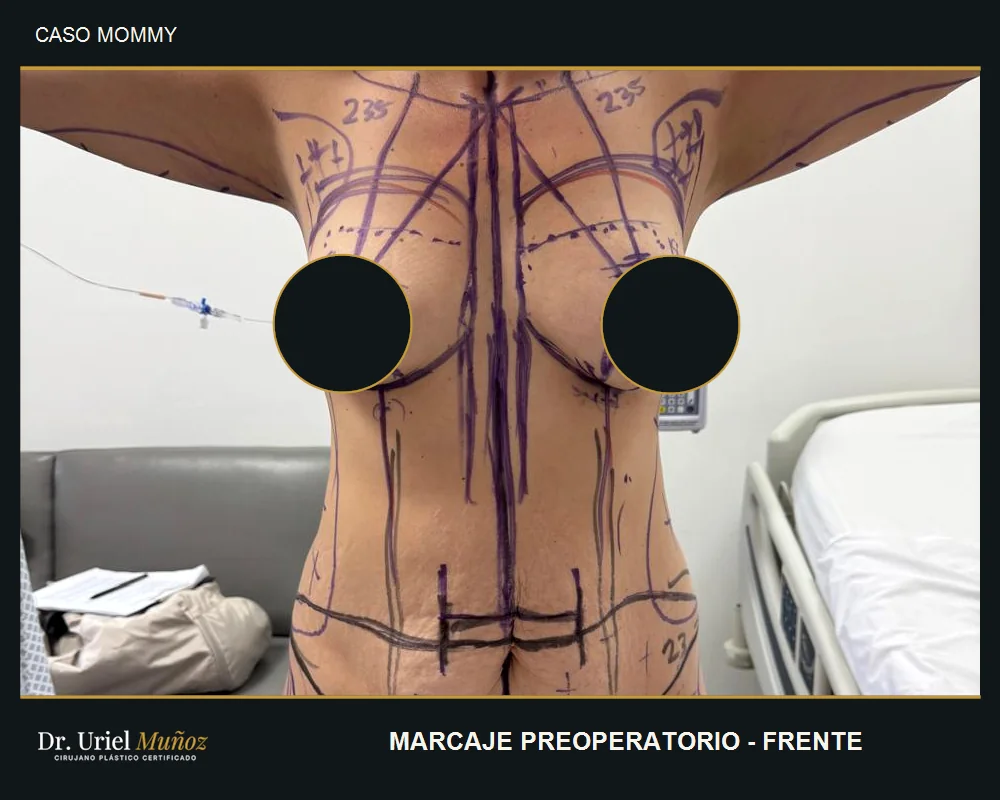 Marcaje previo del abdomen y busto, vista frontal