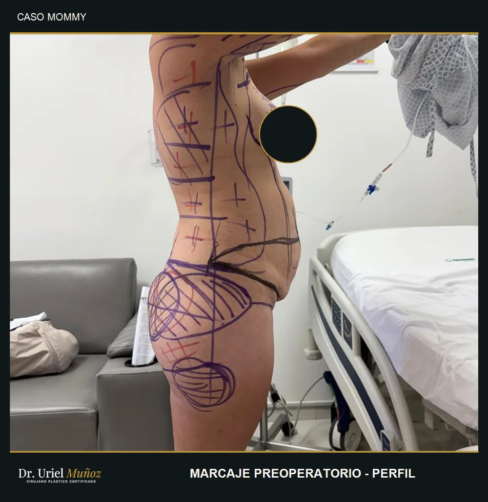 Marcaje previo del abdomen y busto, vista lateral