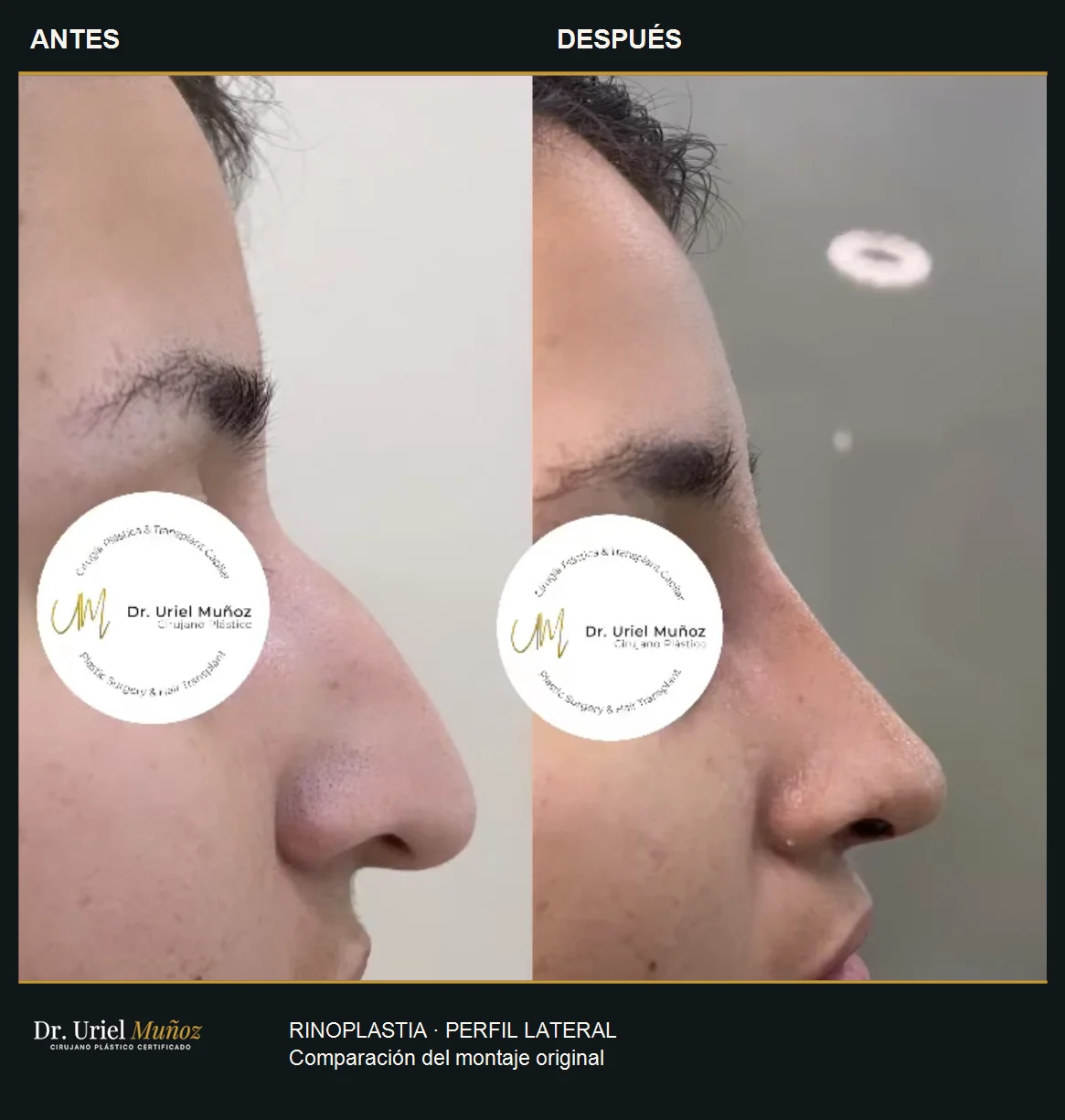 Perfil lateral de un mismo caso de rinoplastia, con los ojos cubiertos por privacidad: antes a la izquierda y después a la derecha
