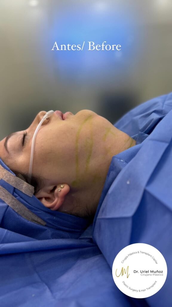 Antes y después de lipopapada mostrando definición del ángulo cervicomental