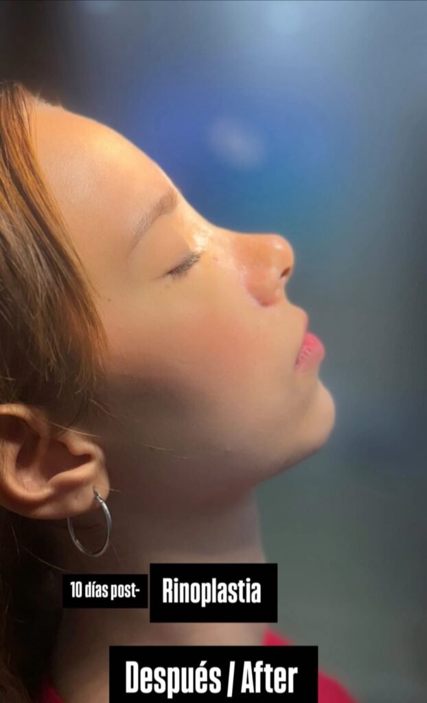 RINOPLASTIA ANTES Y DESPUÉS