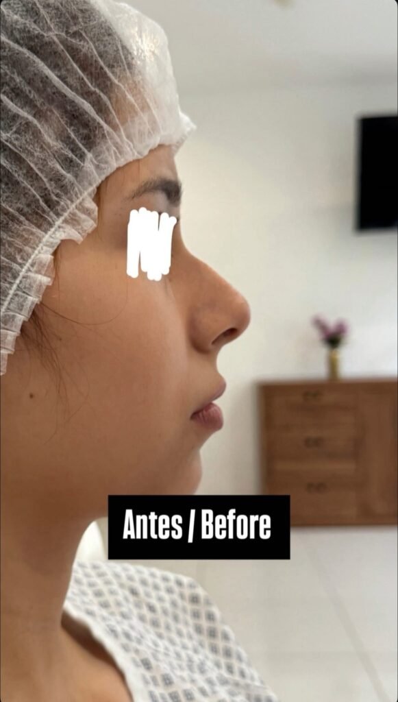 RINOPLASTIA PUERTO VALLARTA