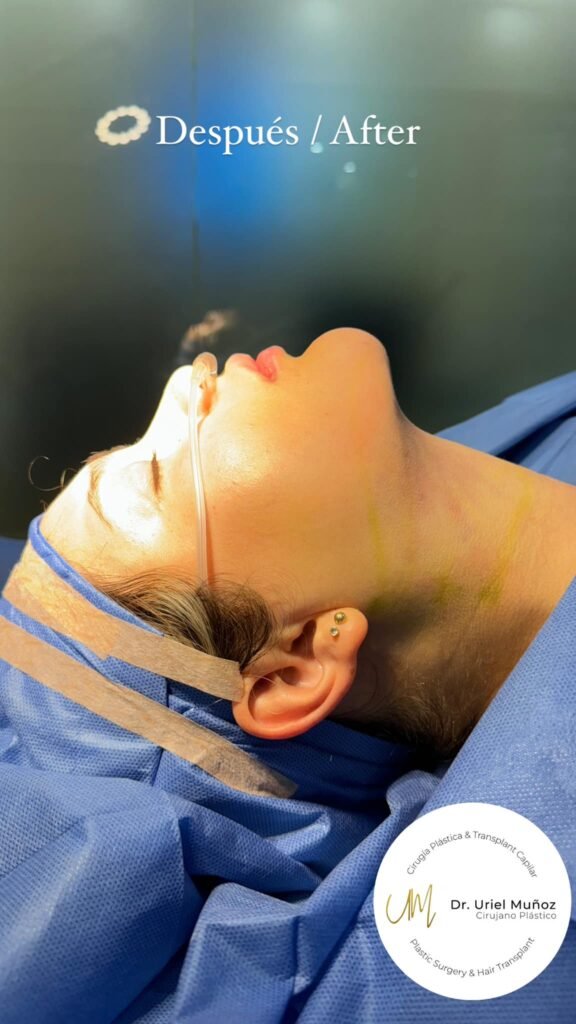 Resultado de lipopapada con mejor definición mandibular